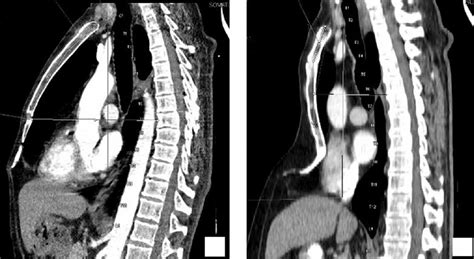 Xiphoid Process Problems 的图像结果