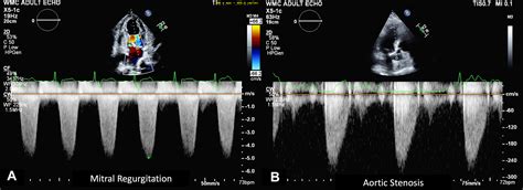 How to Scan Patients With Severe Aortic Stenosis | JACC: Case Reports