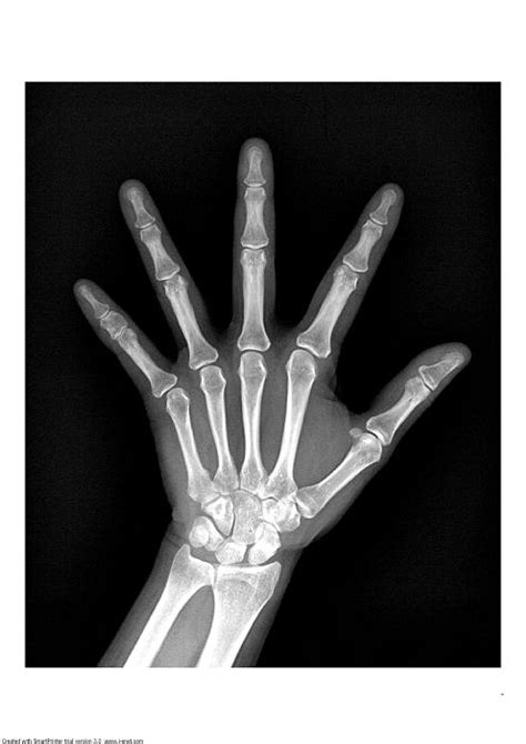 左小手指近节指骨骨折(内固定术)工伤认定能算几级?_第二人生