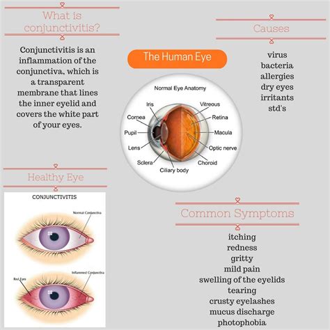 Bacterial Conjunctivitis Treatment