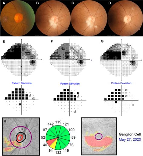 Image result for Visual Field Defects Chart