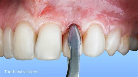Image result for Surgically Remove Tooth