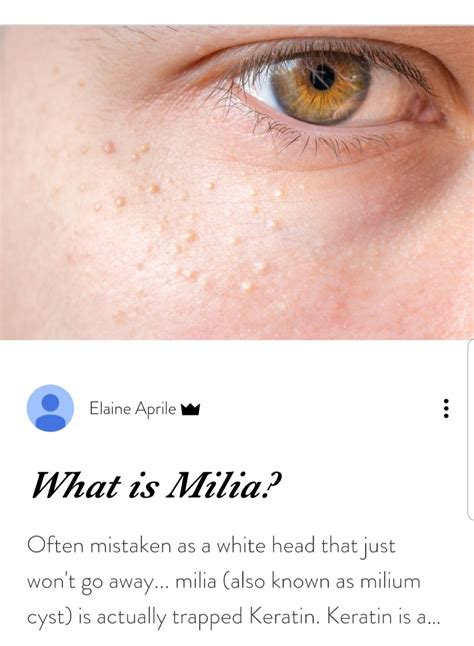 White bumps under eyes milia – Artofit