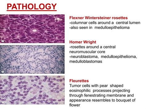 Retinoblastoma | PPTX