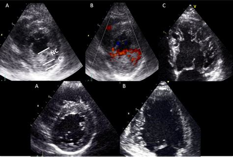 Echocardiographic comparison between left ventricular non-compaction and hypertrophic ...