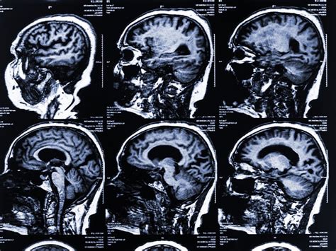 Multiple System Atrophy 的图像结果