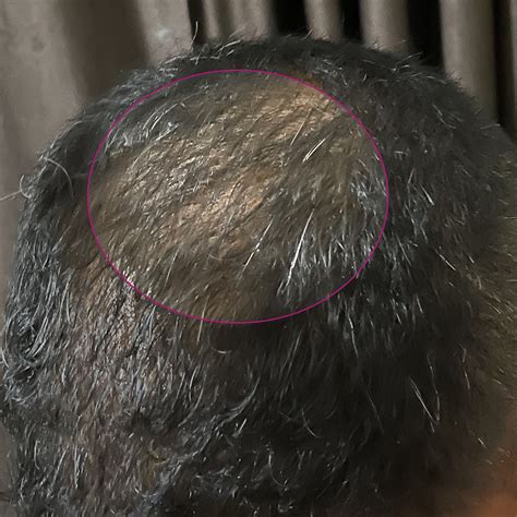 Hair Growth Treatment by Dermatologists | Bontress Pro Serum