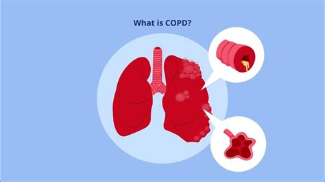 Emphysema Life Expectancy 的图像结果