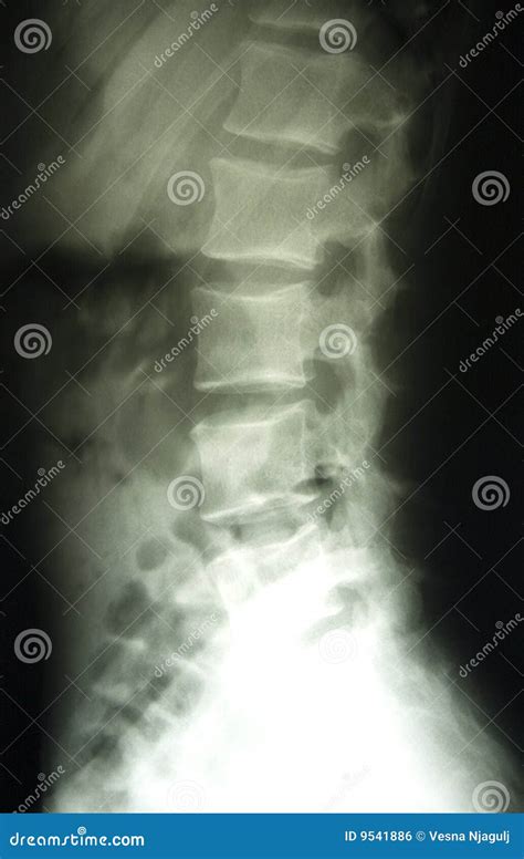 Lumbar Spine X-ray, Lower Back Stock Photo - Image of lower, radiology: 9541886