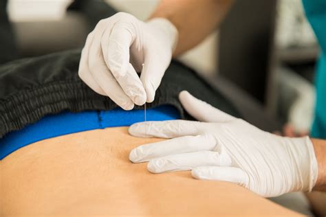 Dry Needling – First Choice Physical Therapy