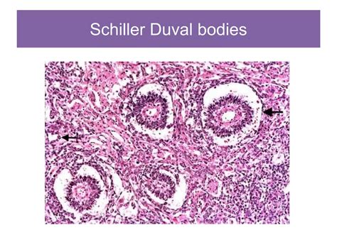 Approach to testicular tumors | PPTX