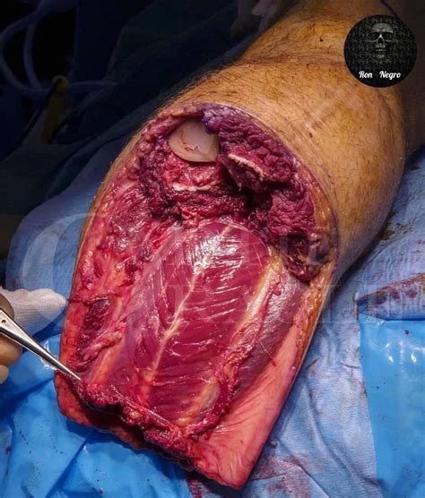 My favorite gore pic ever/Inside of mans leg. - WPD