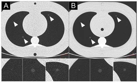 Spectral Photon-Counting CT Technology in Chest Imaging