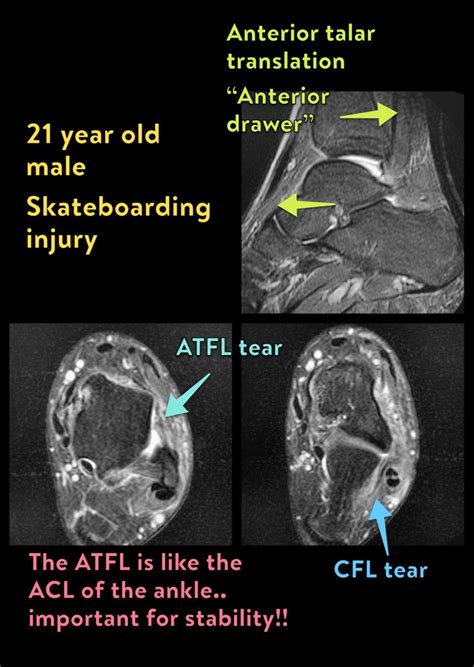 Anterior Talofibular Ligament Ai