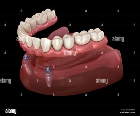 Mandibular removable prosthesis All on 2 system supported by implants with ball attachments ...