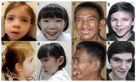 What Causes Barber Say Syndrome at Luis Lam blog