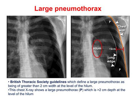 PNEUMOTHORAX IN CHEST XRAY INTERPRETATIONpptx | PPTX