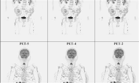 Whole-body PET/CT reduces total scan time in patients with melanoma: Study