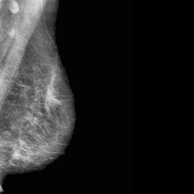 CBIS-DDSM - Dataset Ninja