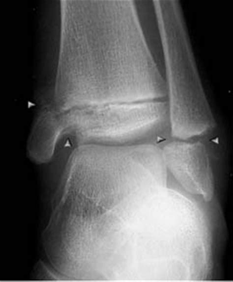 Lateral Ankle X Ray Anatomy