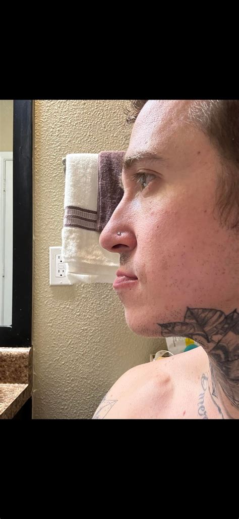 3 months post-op DJS (details in comments) : r/jawsurgery