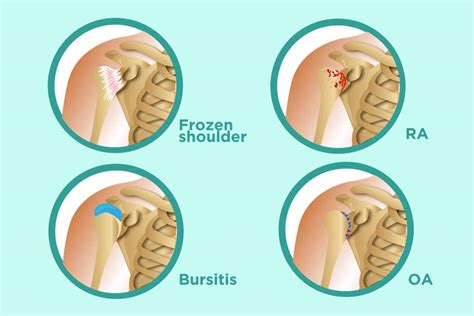 Rheumatoid Arthritis of the Shoulder | USA Spine Care & Orthopedics