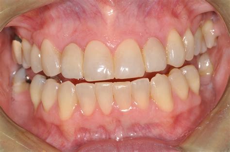 Cosmetic Bonding | Halifax, NS | Dr. Jenine Arab Omalley