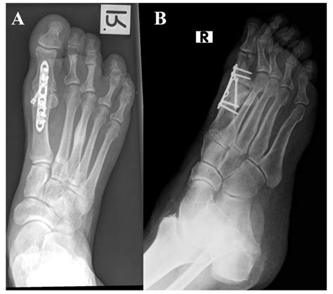 Increased Risk for Non-Union in First Metatarsophalangeal Joint ...