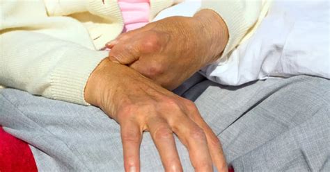 Paralysis 的图像结果