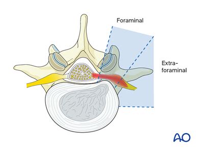 Image result for Foraminal Disc Extrusion