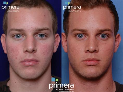 Microdermabrasion Immediately After