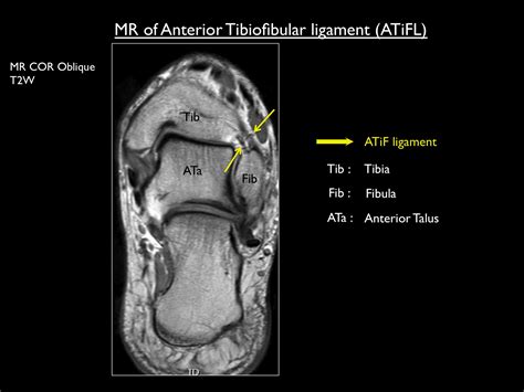 Anterior Tibiofibular Ligament Mri