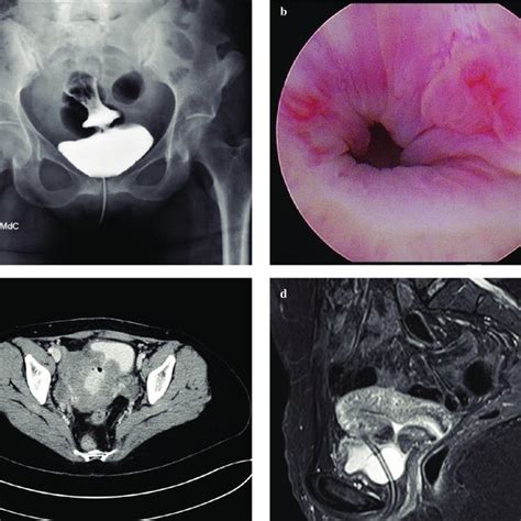 Image result for Cystogram Procedure for CT Scan