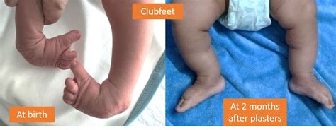 Best Pediatric Orthopedic Surgeon in Mumbai | Dr Mudit Shah