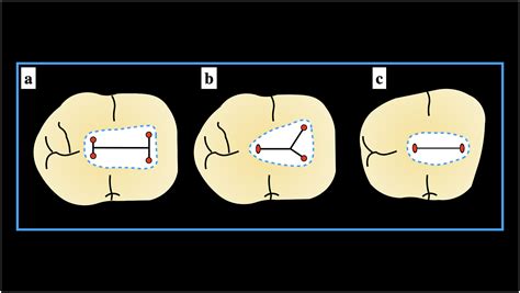 The morphology of the pulp chamber floor of permanent mandibular first ...