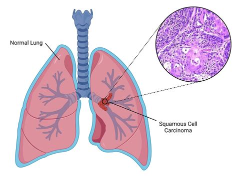 Where Does Squamous Cell Lung Cancer Spread To - Infoupdate.org