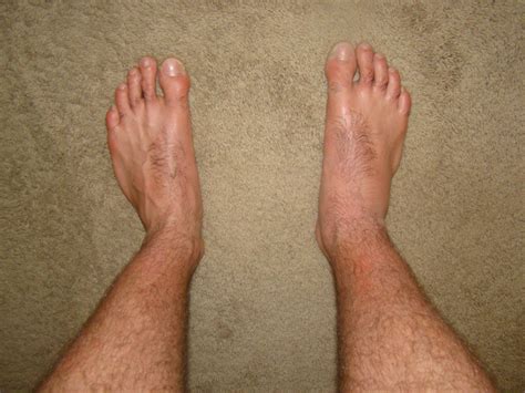 Sprained Ankle Swelling | Comparison of ankle sprain swellin… | Flickr