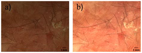 Non-Contact Dermatoscope with Ultra-Bright Light Source and Liquid Lens ...