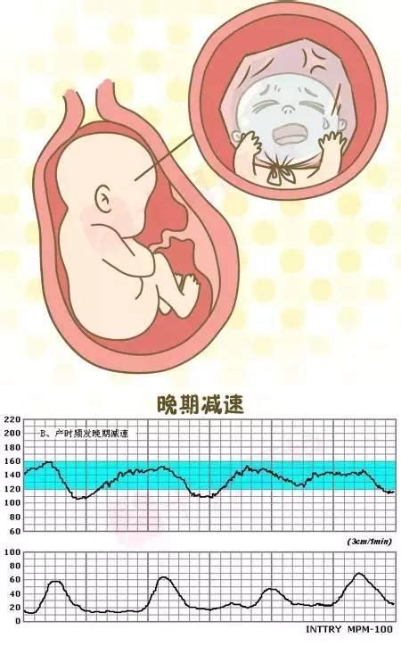 几种特殊的胎儿胎心率图型（一） - 知乎