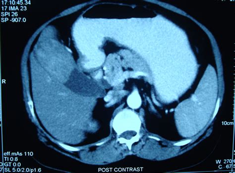 Gallbladder Cancer - Gallbladder Cancer Treatment Case Study