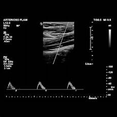 vasi addominali ecografia ed ecocolordoppler protos vasi addominali ecografia ed ecocolordoppler protos
