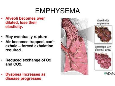 End Stage of Emphysema 的图像结果