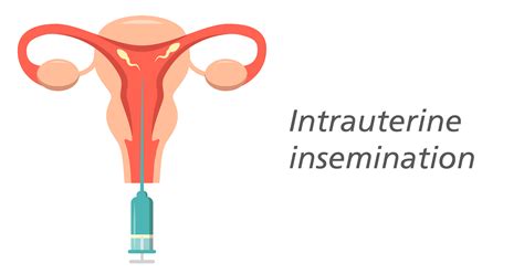 Fresh and Frozen Sperm for IUI and IVF Cycles | Esco Medical