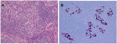 Epstein-Barr Virus (EBV)-associated Gastric Carcinoma