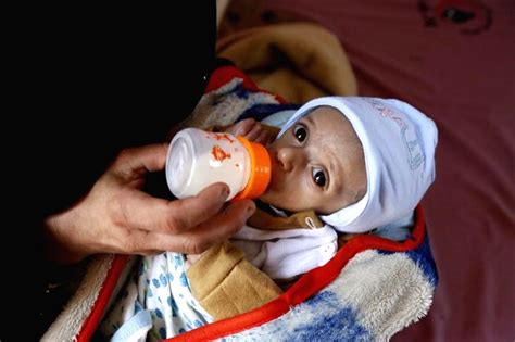 Nutritional crisis during Covid to affect 9.3 mn children by 2022: Experts