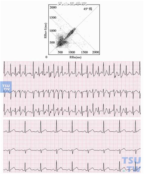心电图病例分析：心房颤动伴完全性左束支阻滞 - 爱爱医医学网