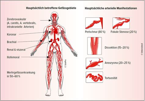 Fibromuskuläre Dysplasie – ein Update - Universimed - Medizin im Fokus