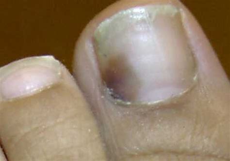 如何识别早期的灰指甲症状图片迹象