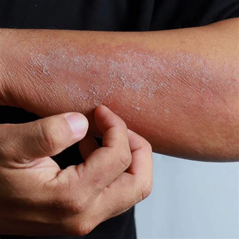 How can Atopic Dermatitis Flares be Managed in Routine Clinics?