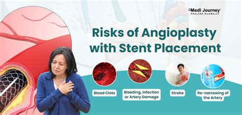 Angioplasty with Stent Placement: How it Helps Open Blocked Arteries